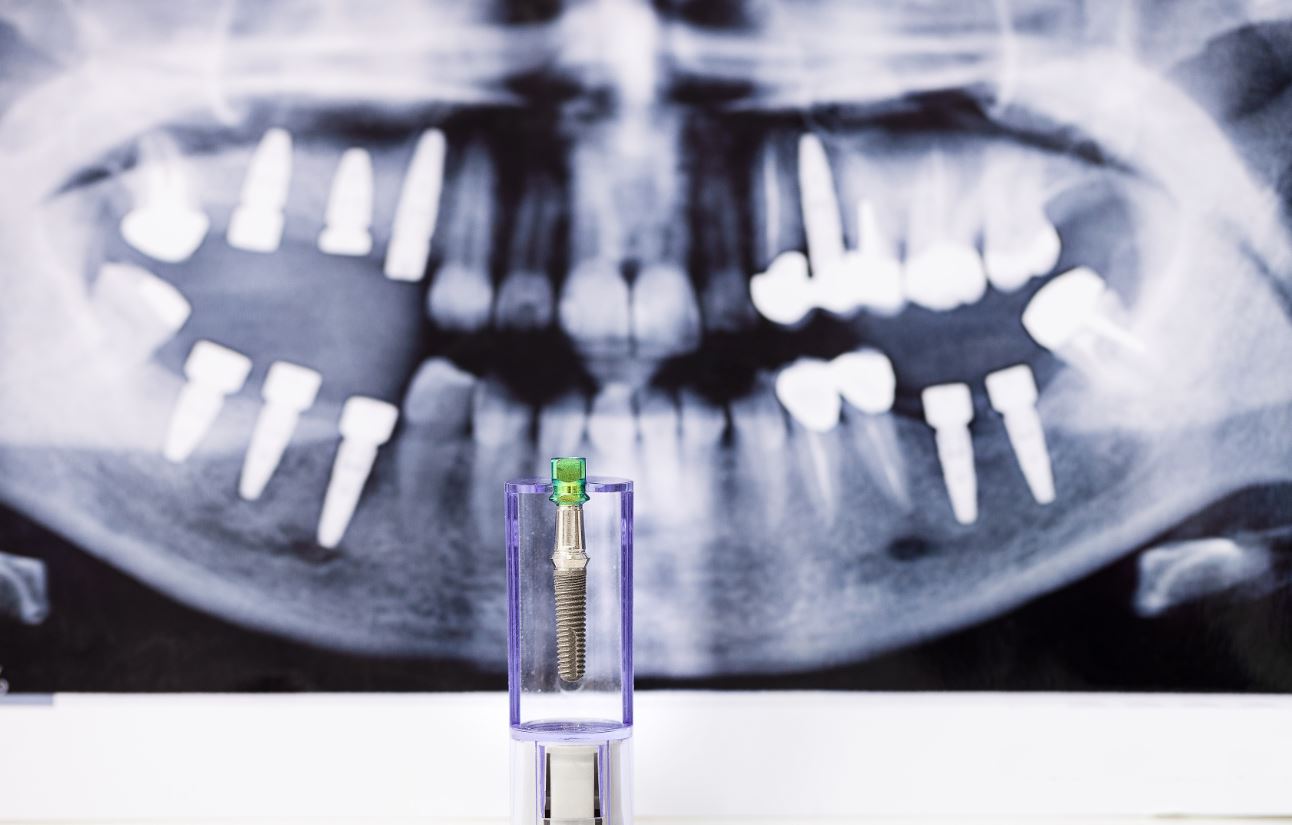 implantes dentales en arganda y azuqueca
